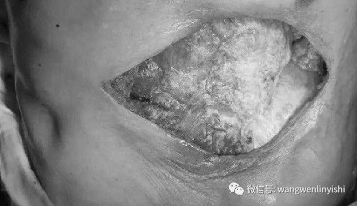 The chest wall defect was repaired using Matrix RIBs