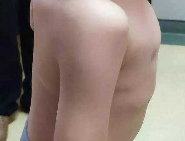 Surgery for A 4-year-old Child with Straight Back Syndrome and Chest Wall Deformity