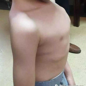 The entire chest wall is protruding, with the most prominent protrusion located on the upper chest wall