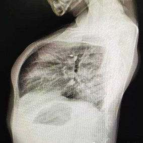 The X-ray shows a protruding anterior chest wall and a loss of normal spinal curvature