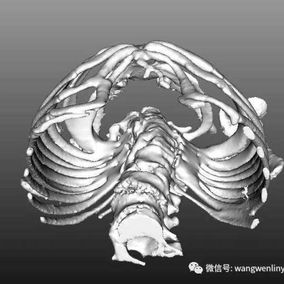 The 3D image shows a protruding chest wall and a loss of normal spinal curvature