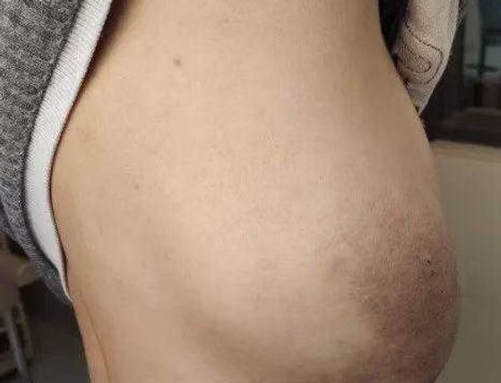 Chest Wall Tumor Resection and Chest wall Reconstruction for A 20-year-old Patient