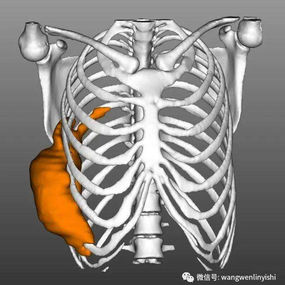 The chest wall tumor has affected multiple ribs on the right side