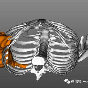Location of the right chest wall tumor (axial view)