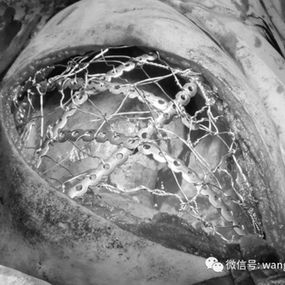 Reconstruction of the right chest wall using MatrixRIBs