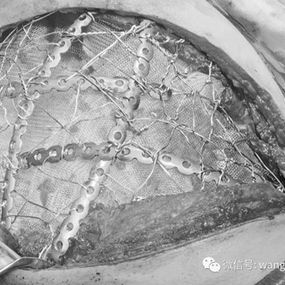 The internal surface of the MatrixRIBs was lined with a layer of fibrous membrane