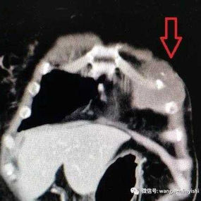 The CT scan shows the location of the chest wall tumor, which impacts the bone structure of the chest wall and the pericardium