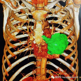 The 3D image shows the location of the chest wall tumor, involving multiple ribs, costal cartilage, and the lower chest wall