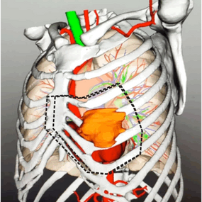 The area of tumor resection simulated by computer