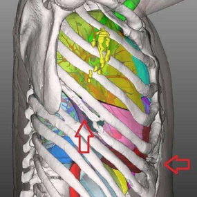 Localized destruction of bone structure in the chest wall
