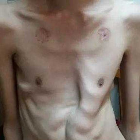 A 16-year-old Patient with Severe and Rare Complex Chest Wall Deformities