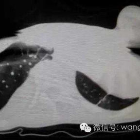 The CT image indicates a deformed protrusion on the left anterior chest wall, and the heart is significantly compressed.