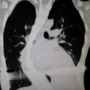 The CT image shows scoliosis, with the heart located in the left chest cavity and a Nuss bar positioned against the anterior surface area of the heart