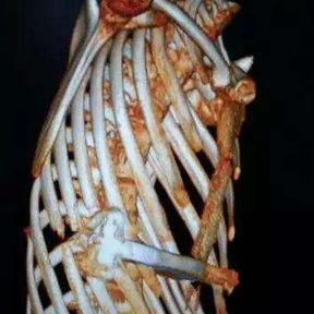 The 3D reconstruction indicates severe chest wall deformities with significant structural damage.