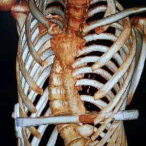 The 3D reconstruction indicates chest wall deformities, scoliosis, and asymmetry of the chest wall. The shadow of the Nuss bar is visible.