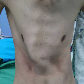 Severe chest wall deformity