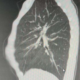 Severe chest wall deformity