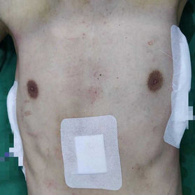 The chest wall appearance was essentially normal after the surgery