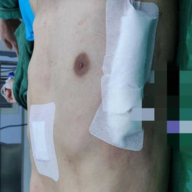 Postoperative chest wall appearance