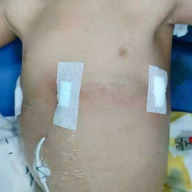 Postoperative chest wall appearance