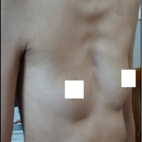 Pre-operative appearance of the chest wall