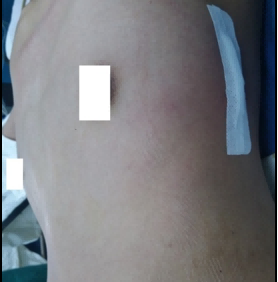 Post-operative appearance of the chest wall