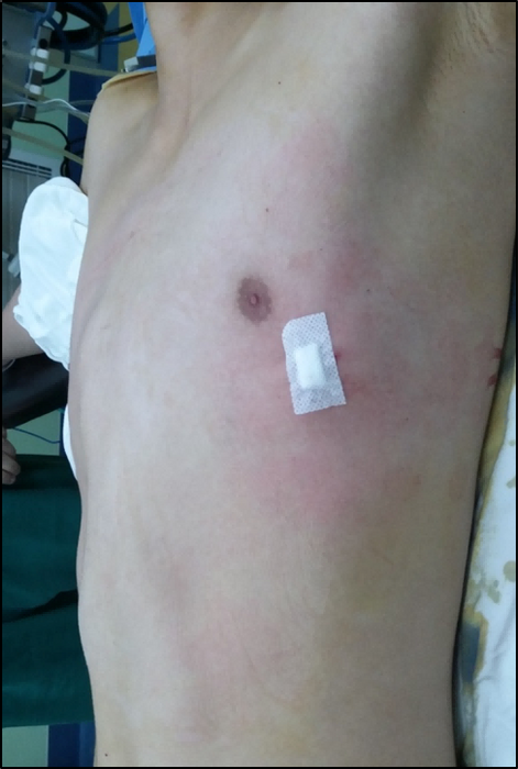 Post-operative appearance of the chest wall