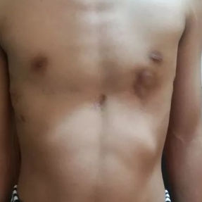 The chest wall exhibits a groove-shaped depression, along with visible scars from the previous surgery and an abscess on the left chest wall.