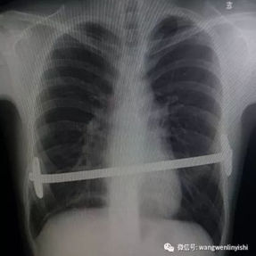 X-ray examination shows the Nuss bar is tilted and the spine is slightly scoliotic.