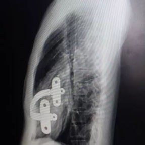 X-ray examination indicates a localized depression in the lower part of the anterior chest wall, with the bar positioned at an angle.