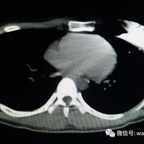 CT scan shows the fixation site of the bar in the left side of the chest wall.