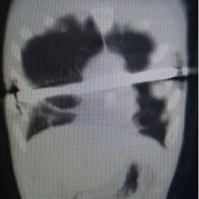 CT shows that the bar is tilted.