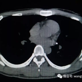 CT scan shows the bar has integrated into the soft tissues of the chest wall.