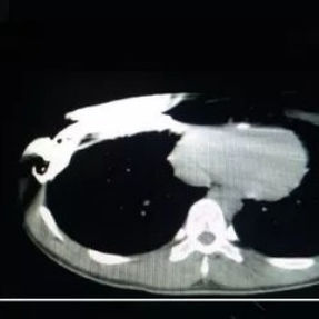 CT features of grooved chest. No clear central depression, but varying anterior-posterior diameters at different levels.