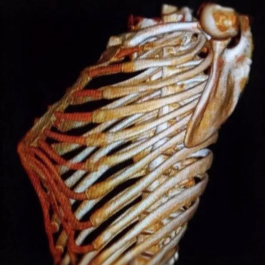 Pre-shaping: revolutionizing the treatment of severe and complex chest wall deformities