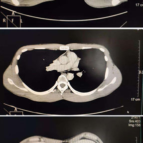 The CT scan shows that the upper section of the chest wall is normal in shape, while the lower section shows signs of flat chest.