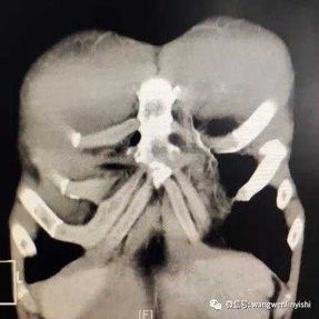 The CT scan reveals the location of the groove-shaped depression