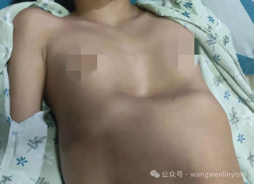 Severe asymmetric depression deformity