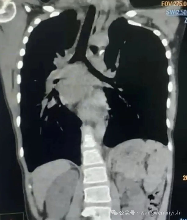 Distortion of the mediastinal structures