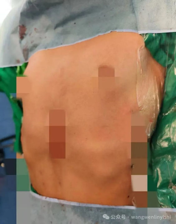 Postoperatively, the chest wall deformity was fully corrected