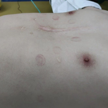 Persistent chest wall depression after Ravitch procedure