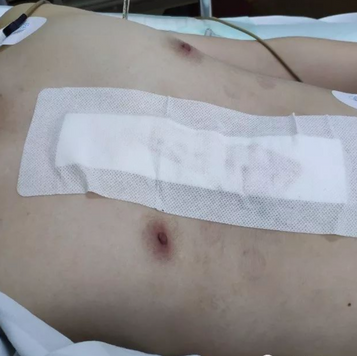 The chest wall deformity disappeared after the surgery