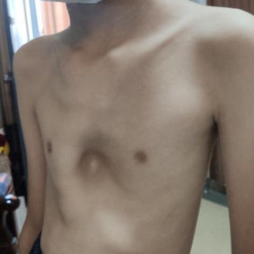 Severe depression of the anterior chest wall with ridge-like protrusion on the right edge