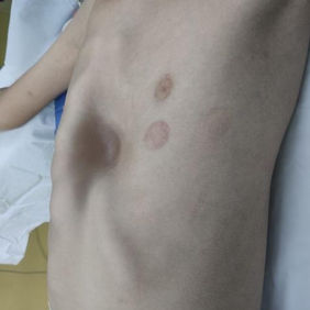 Severe depression of the anterior chest wall with ridge-like protrusion on the right edge