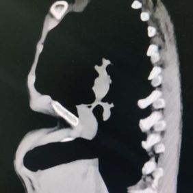 Acute angle deformity at the bottom of the depression