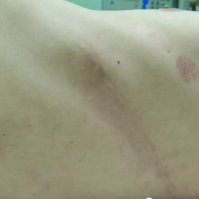 Old surgical scar on the left chest wall