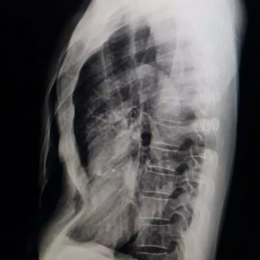 Lateral X-ray showing severe depression of the anterior chest wall and significant heart compression