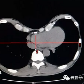 CT scan showing severe depression of the anterior chest wall with a Haller index of 5.6