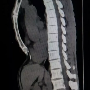CT scan(lateral view) showing depression at the lower anterior chest wall