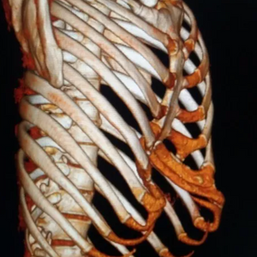 3D reconstruction showing severe chest wall deformity